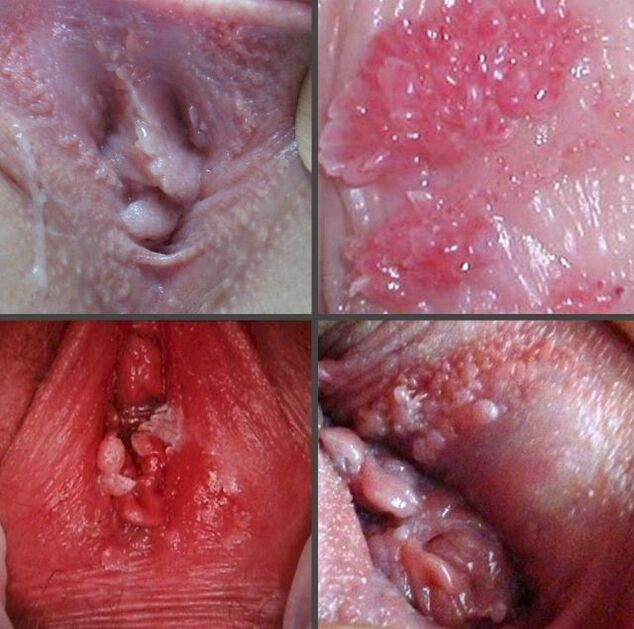 Изблиза папилома у вагини