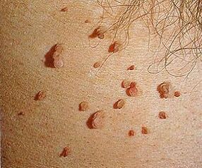 хумани папилома вирус на кожи
