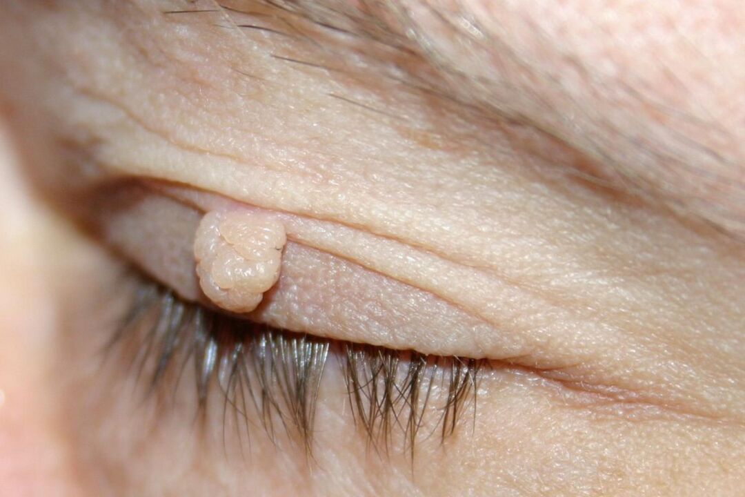 симптоми папилома на очним капцима