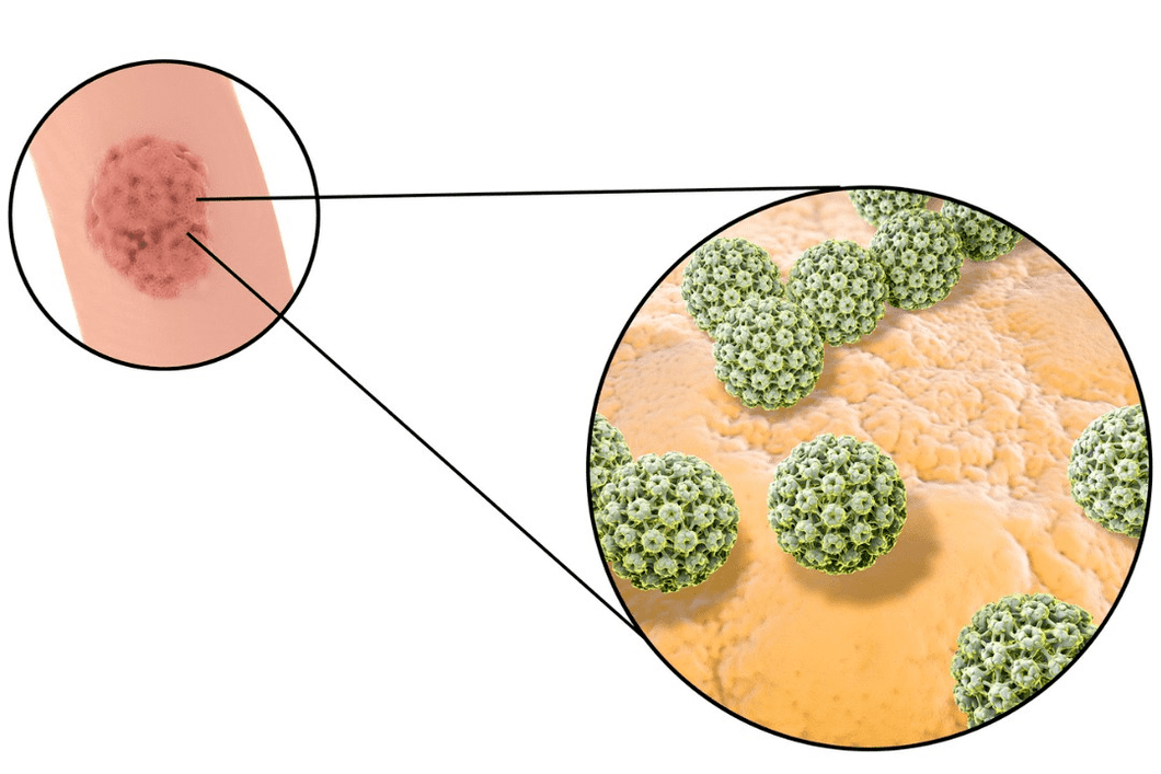 извор инфекције папиломом сквамозних ћелија